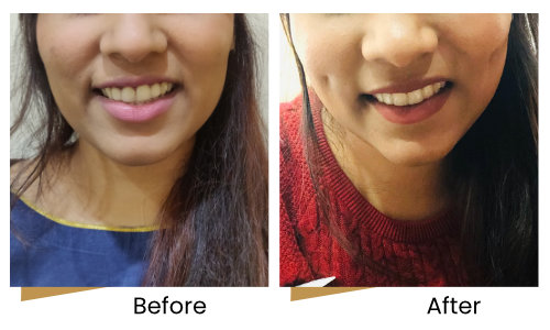 Best Dimple creation in Mumbai