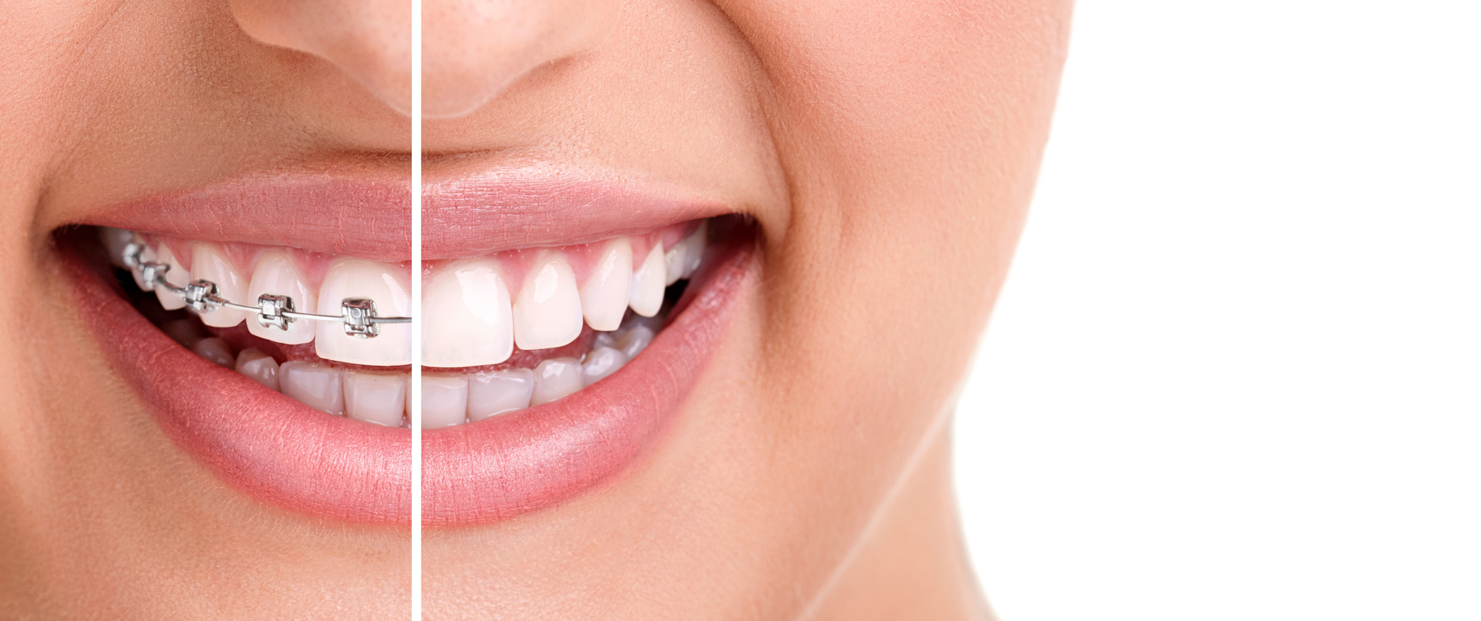 5 Benefits of Braces Treatment for Your Teeth