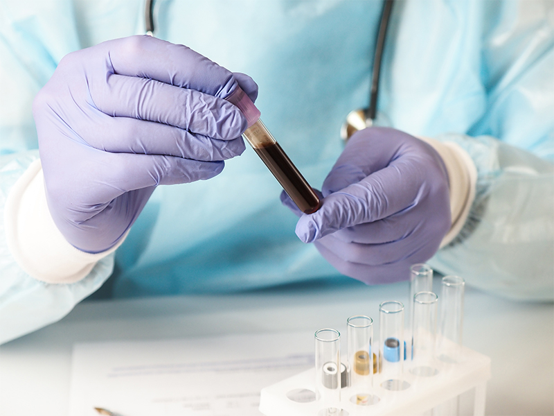 Four Things You Must Know Before a Blood Test in Ahmedabad