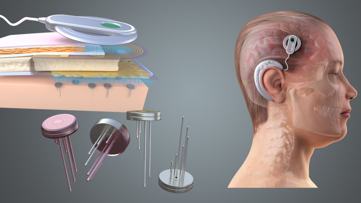 Brain implants Market