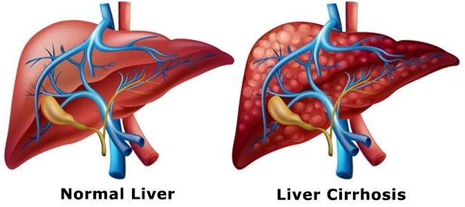 Liver Cirrhosis Treatment in Kochi, India