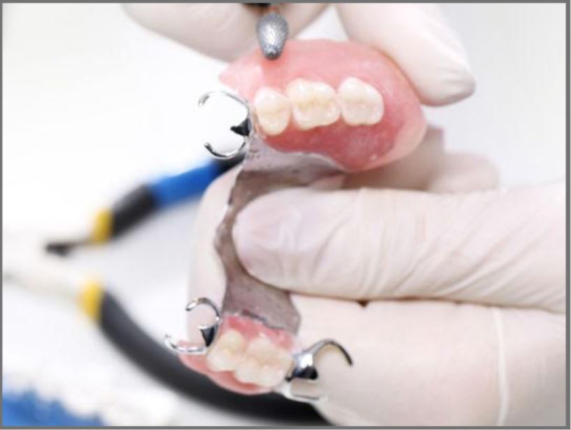 Dealing with partial denture and tooth-colored partial clasps