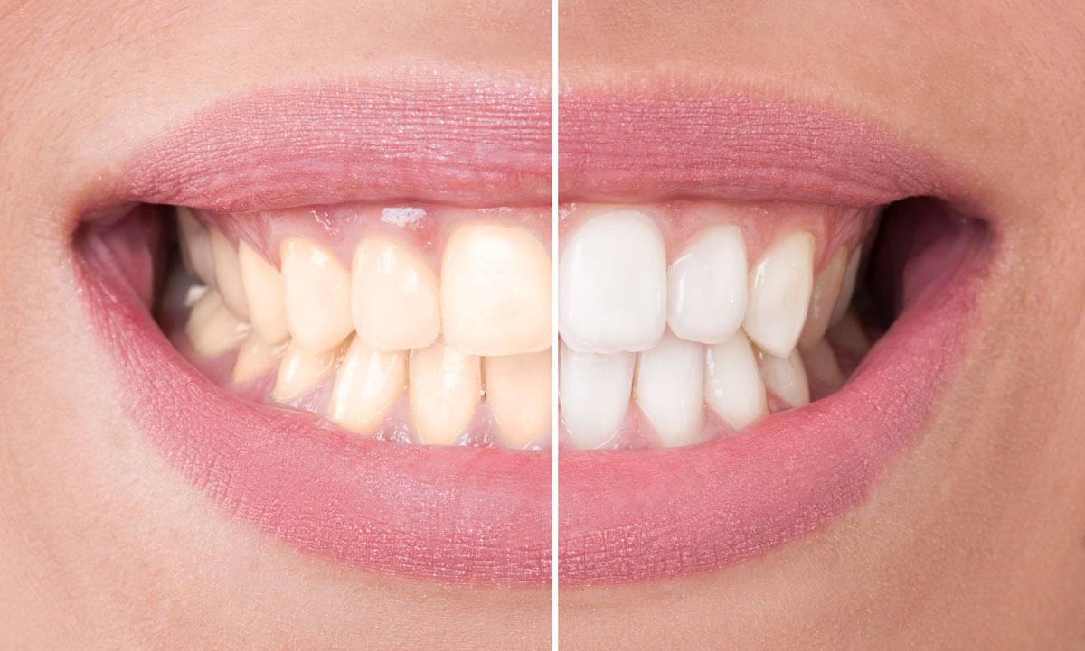 Teeth whitening in Islamabad