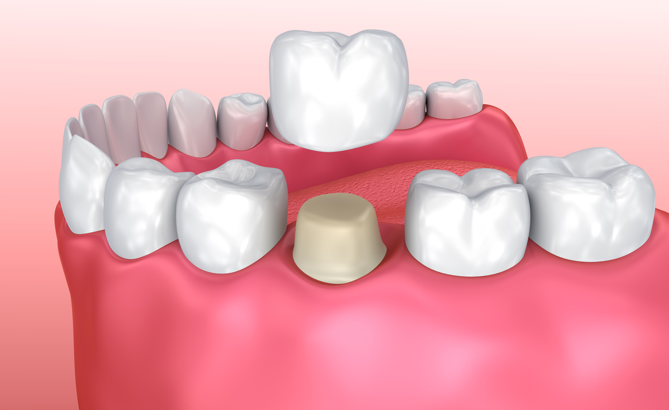 Is a Dental Crown Necessary After Root Canal Procedure?