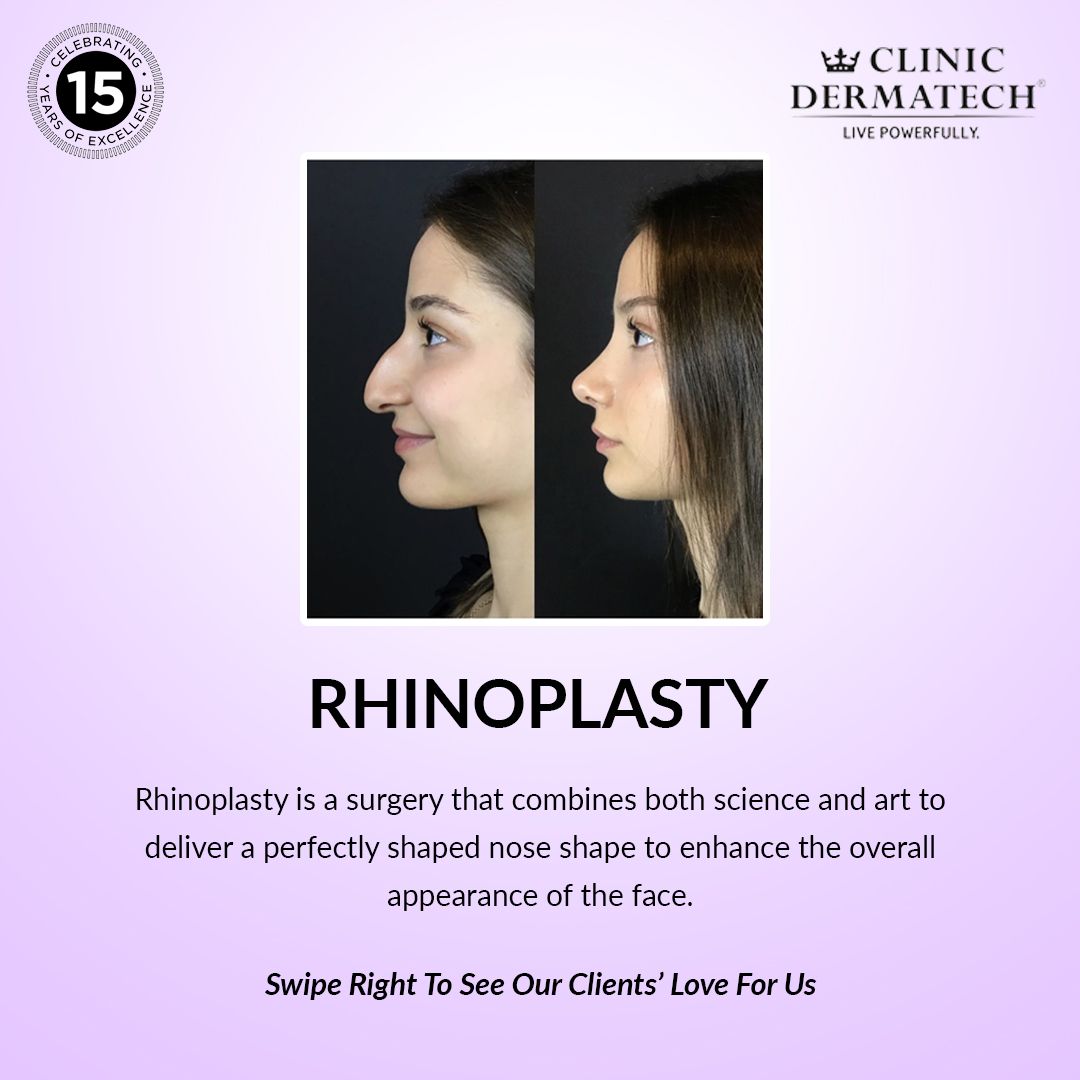 How To Choose Between Surgical and Non-Surgical Rhinoplasty Treatment