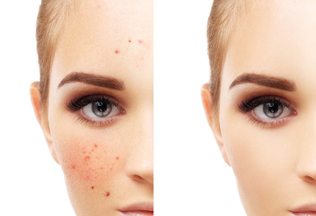 5 Face Pigmentation Solutions From Top Dermatologists