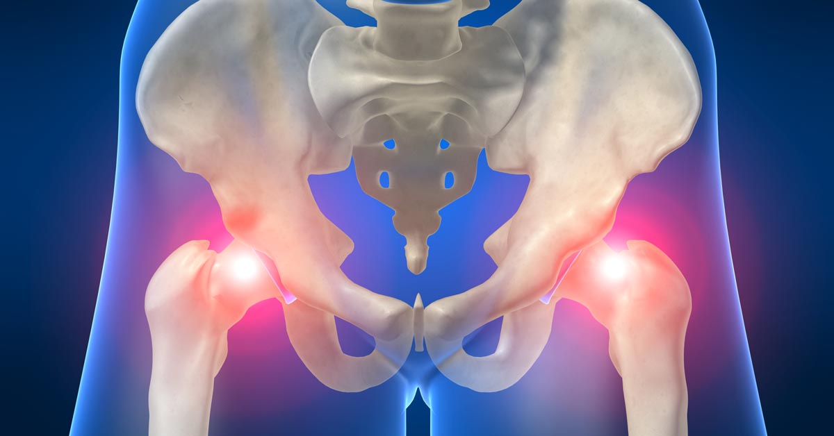 Is Chiropractic More Effective for Sciatica Than Surgery?