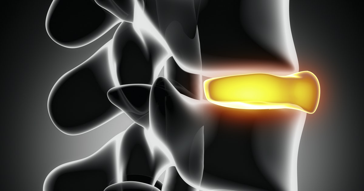 Chiropractic Treatment for Herniated Disc Problems | Gresham Chiropractor