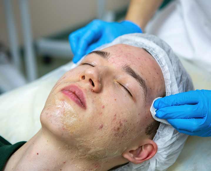 Get Healthy Skin with Dr. Nivedita Dadu's Acne Treatment in Delhi