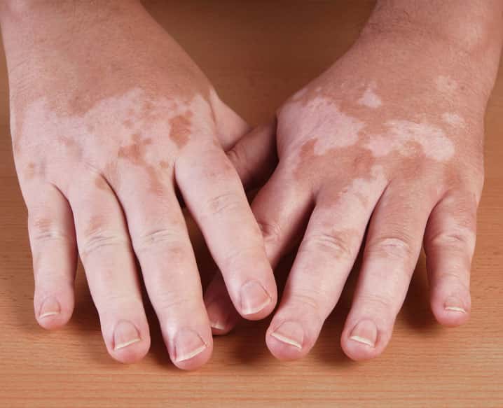  Can Vitiligo Spread? Here's What One Need to Know