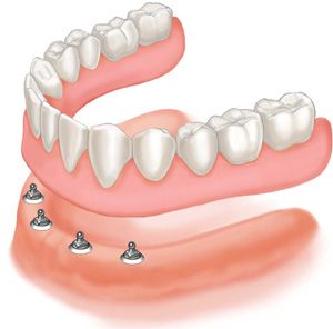 Tips for Choosing the Best Dental Implant Specialist