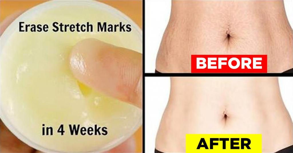 5 Ingredients to Try for Stretch Marks at Home