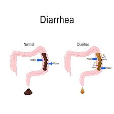 Diarrhea Market Size, In-depth Analysis Report and Global Forecast to 2027