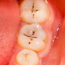 Report on Dental Caries Detectors Market Research 2027 - Value Market Research