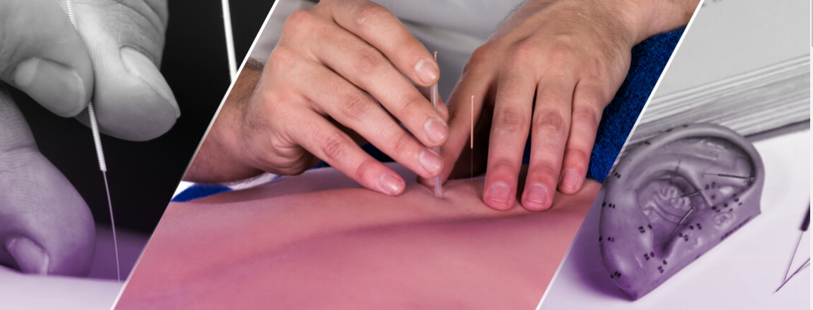 St. Albert Acupuncture