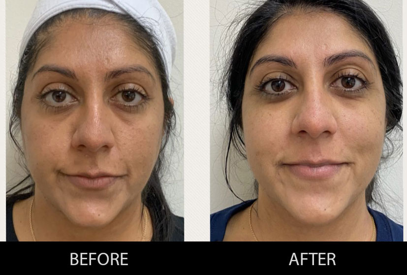 Which are the most effective skin tightening treatments?