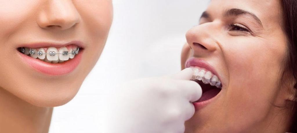 What are the types of braces?