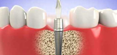 Where is the best place to get dental implants in India?