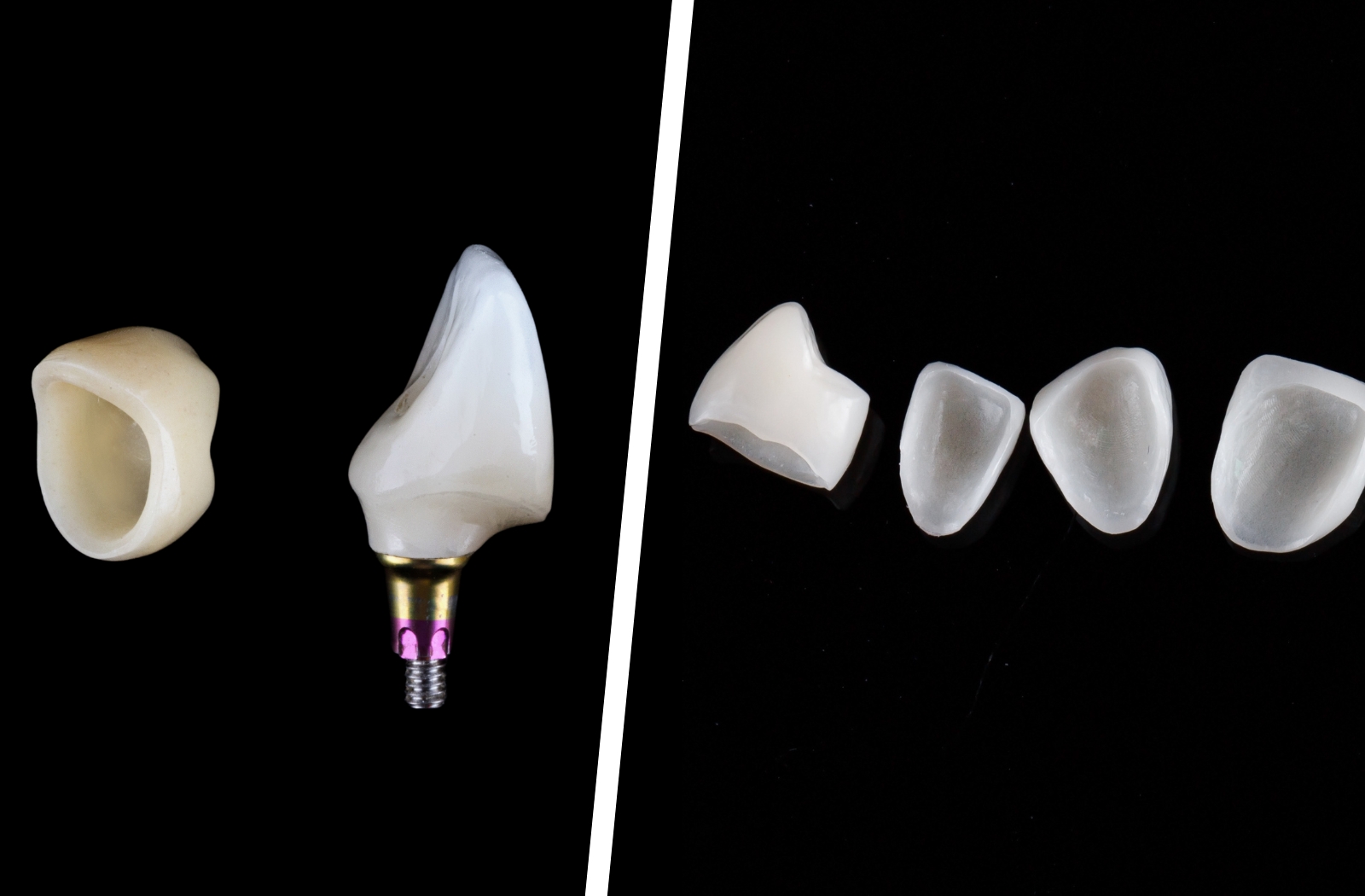 Dental Veneers vs Dental Crowns: Differences & Pros 