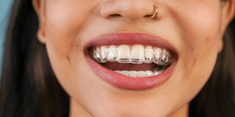 Why More Patients Are Choosing Invisalign in Walterboro