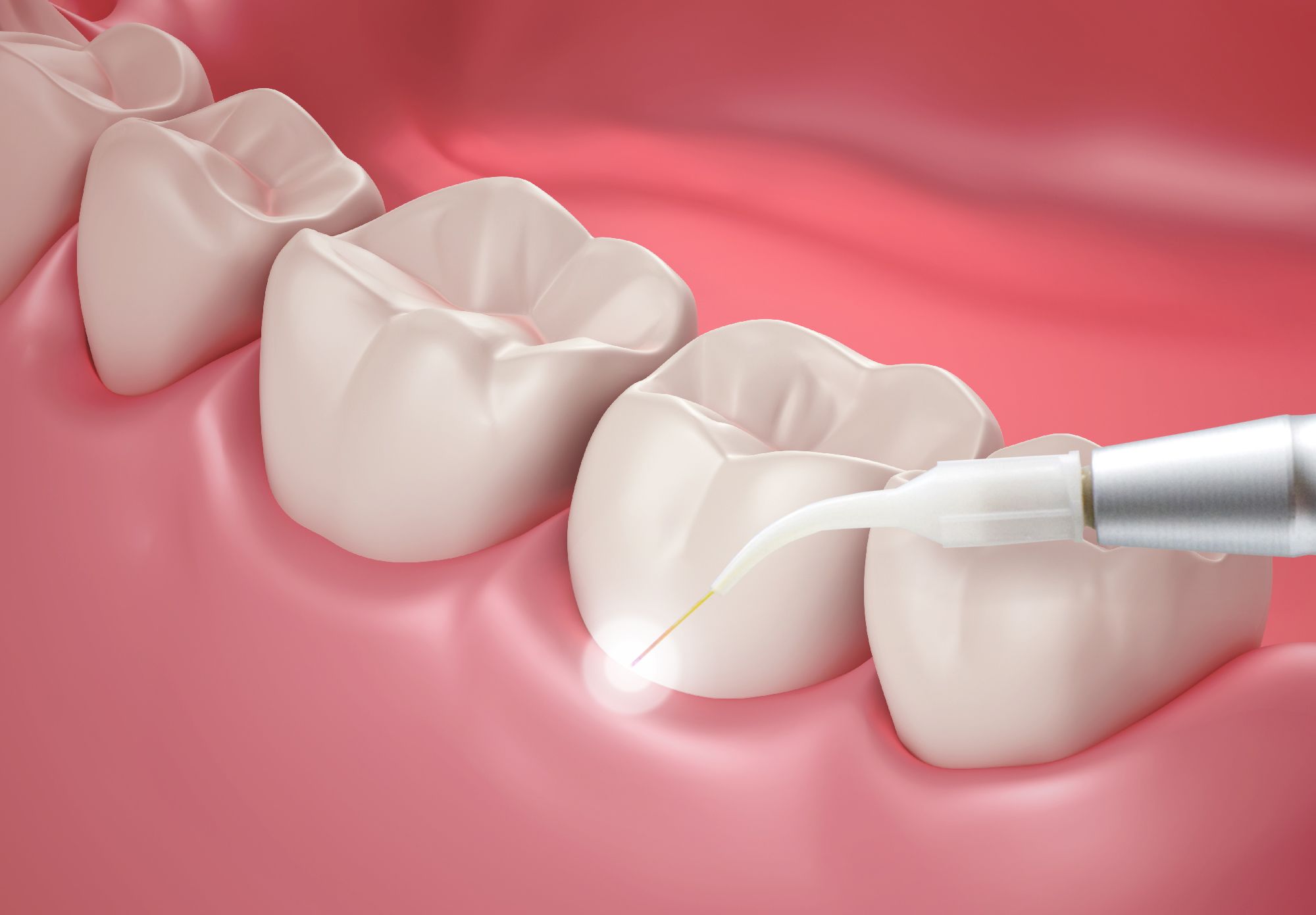 Wisdom teeth removal surgery: what to expect