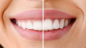 How Effective is LANAP Laser Gum Surgery?