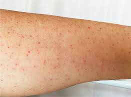 Immune Thrombocytopenia Market Size, Share, Growth, Opportunities and Global Forecast to 2027