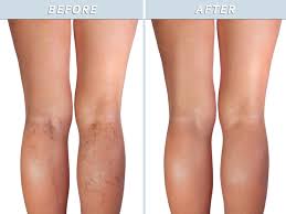 Varicose Veins Treatment Market Size, Status, Growth | Industry Analysis Report 2020-2027