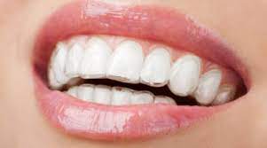 Clear Aligners Market 2020 Market Size, Growth Factors & Forecast Report to 2027