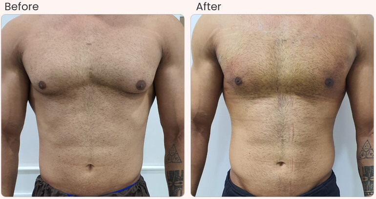 How Long Does Gynecomastia Affect a Male Person?