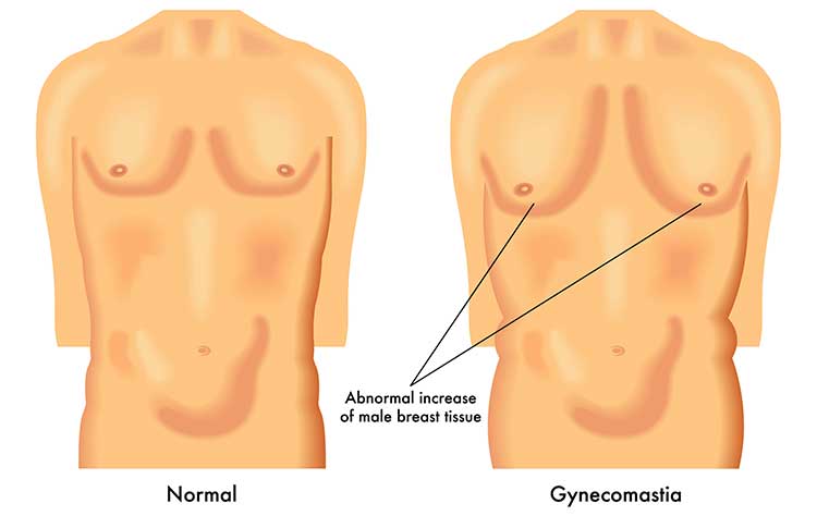 Select the best Gynecomastia treatment in Hyderabad