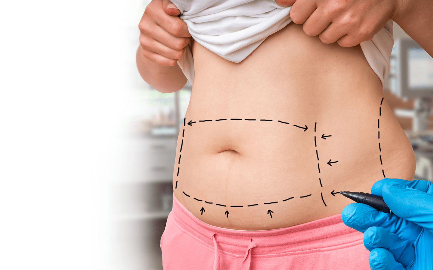 What Are the Types of Liposuction Surgery?