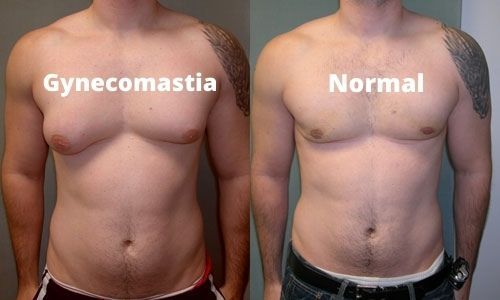 Find the best Liposuction Surgery in Delhi