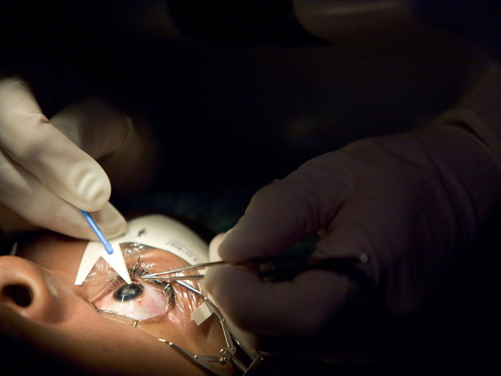 Find Affordable Cataract surgery in Hyderabad