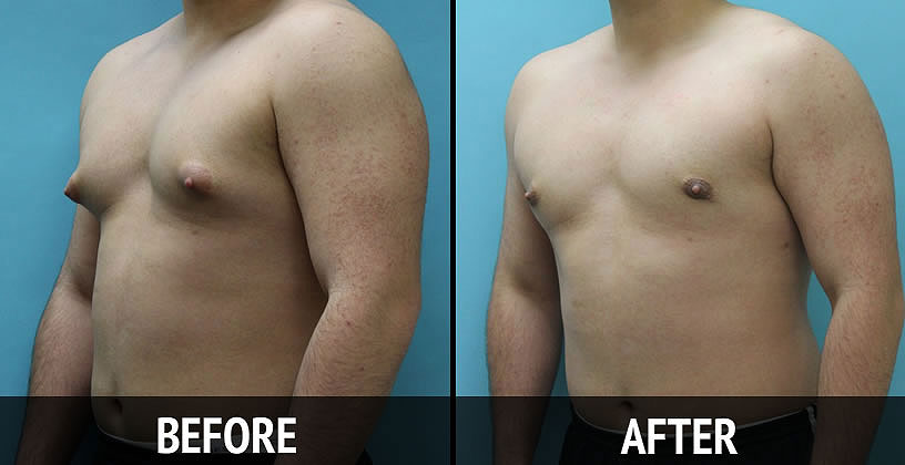 Side Effects of Gynecomastia