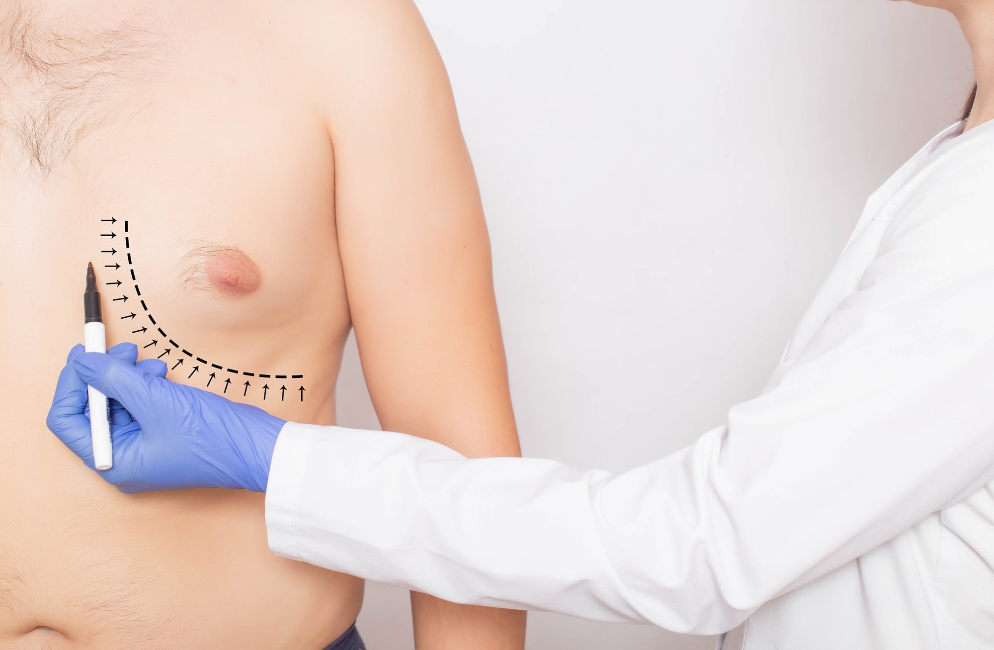 Gynecomastia Treatment Without Surgery