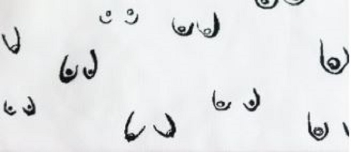 Non-surgical capsular contracture treatment in CA