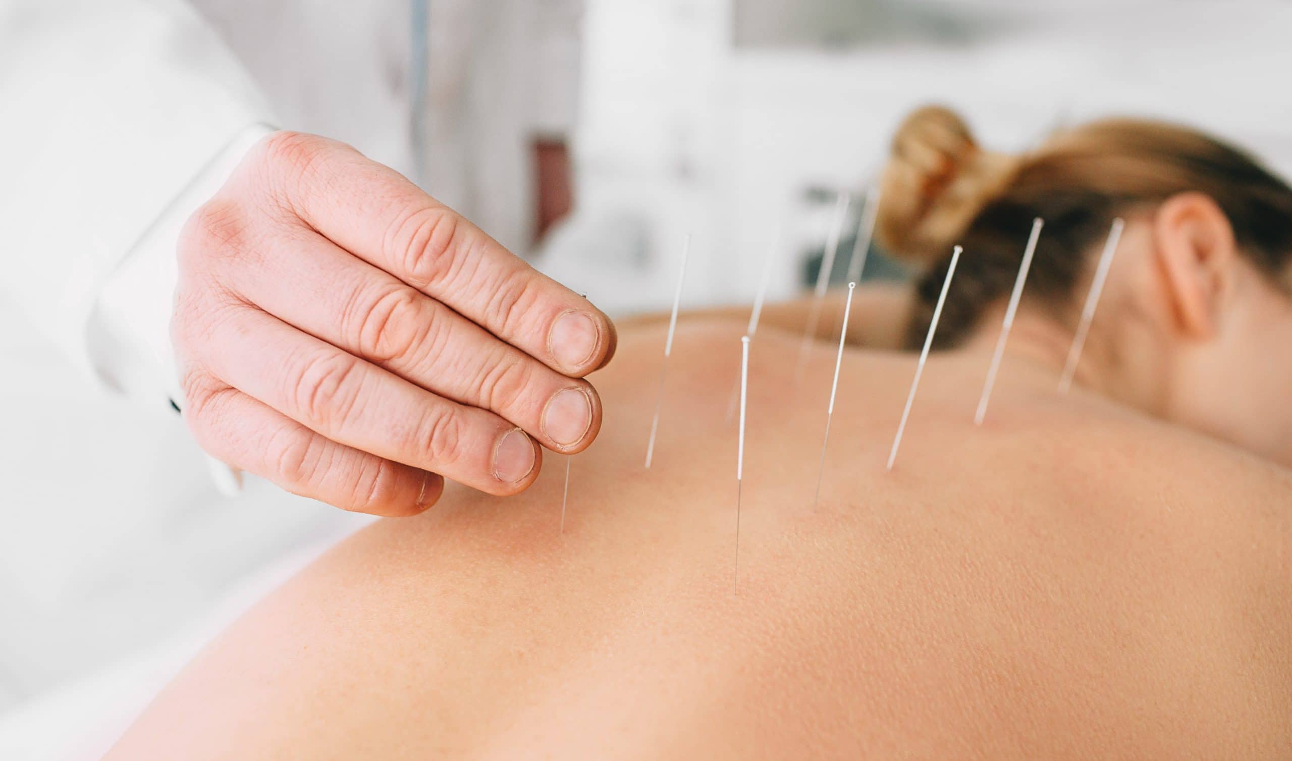 Acupuncture Treatment Brampton