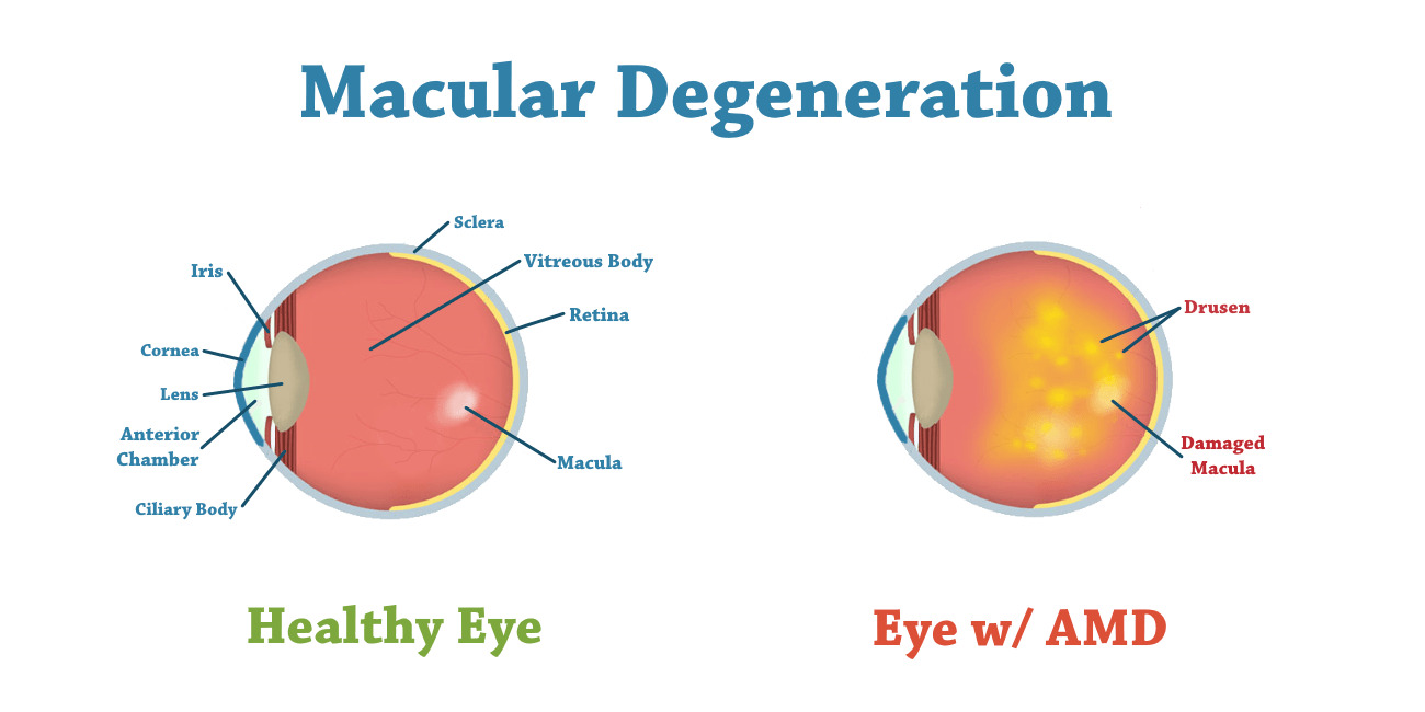 Macular Degeneration - Symptoms, Causes, and Treatment