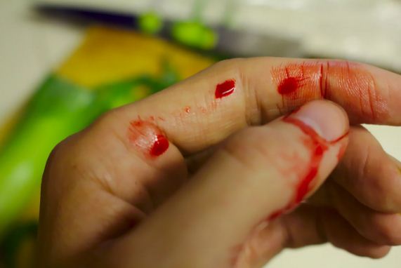  Fingernail Injury: Causes, Symptoms, and Treatments.