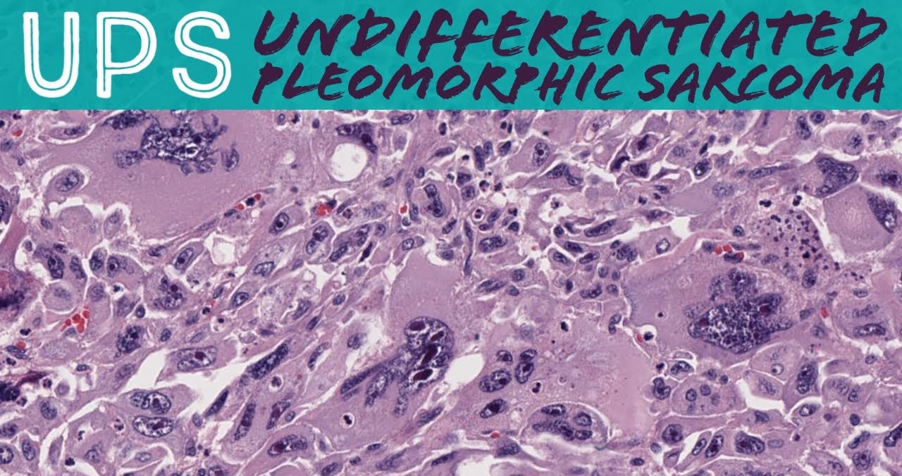 Undifferentiated Pleomorphic Sarcoma - Symptoms, Causes, and Treatment
