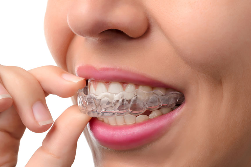 What Benefits Does Invisalign Offer?