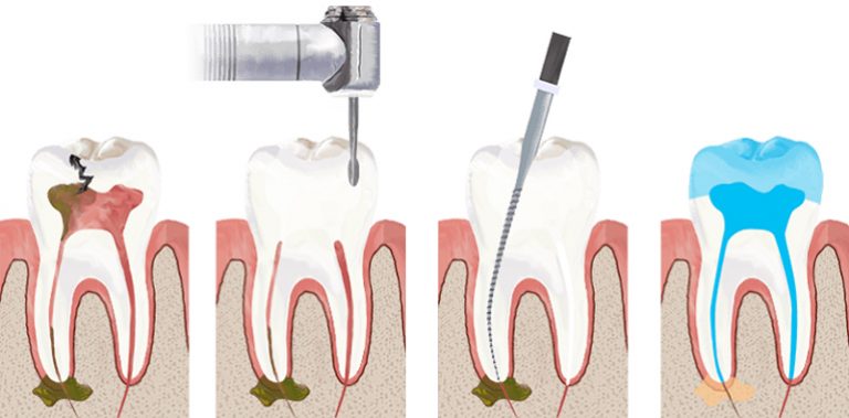 5 Tips To Prepare For Root Canal Treatment