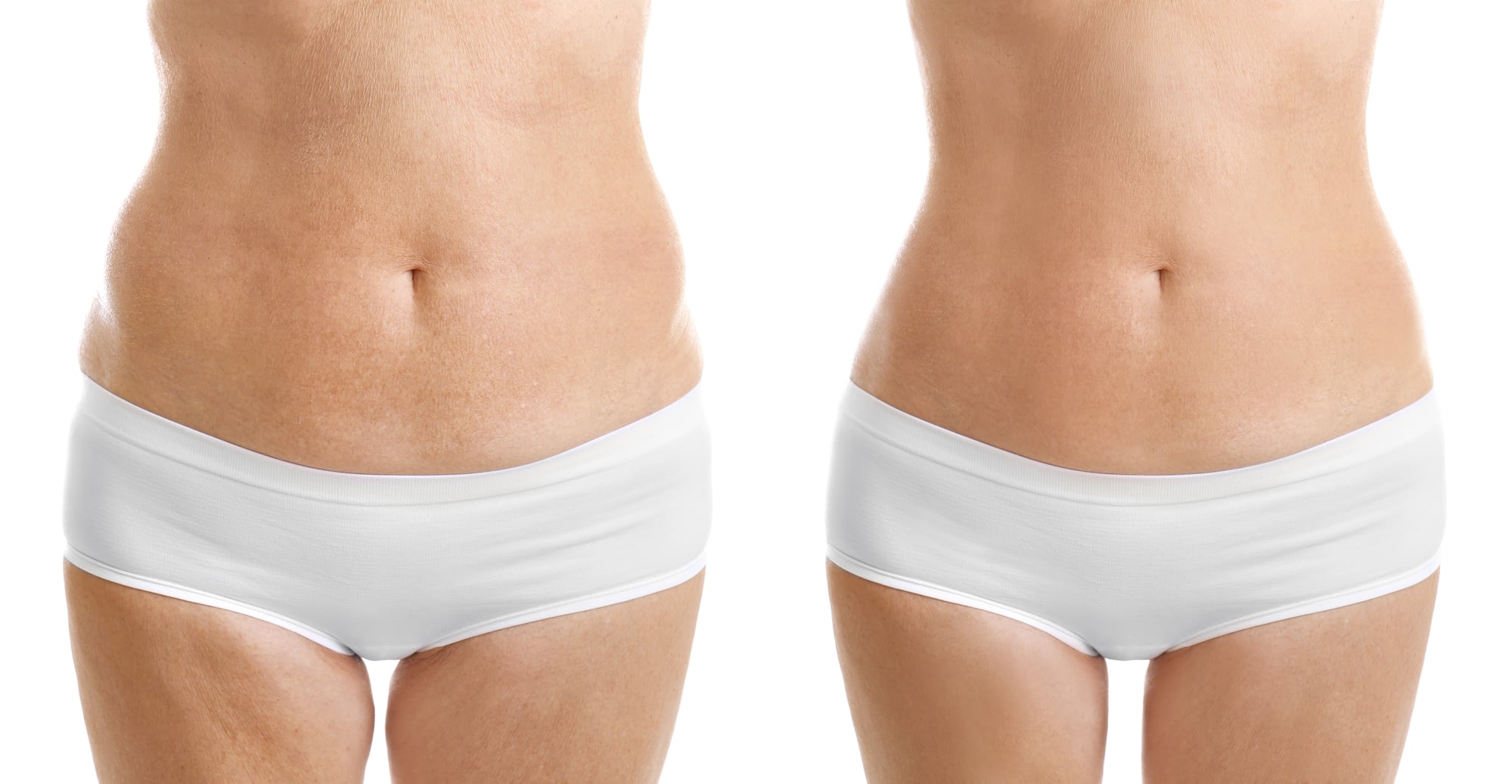 Why is Fat Transfer Liposuction Popular?