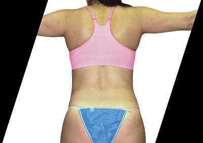 5 Key Procedures Included in a Mommy Makeover Surgery