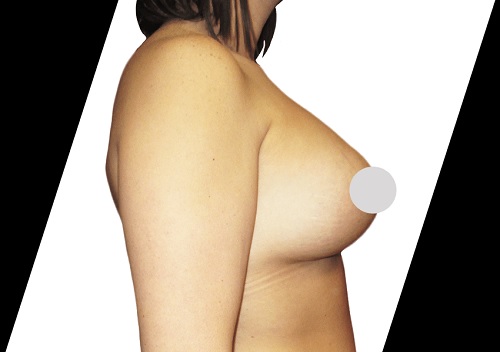 When Is the Right Time for a Breast Implant Revision in Houston?