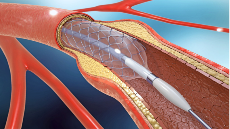 Drug Eluting Stents Market 2021 Analysis Report by Recent Developments and Emerging Technologies Till 2027