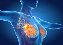 Metastatic Breast Cancer Treatment Market 2020 Size, Dynamics & Forecast Report to 2027