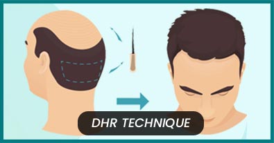 Hair Transplant – How Advance The Treatment Has Become