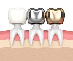 Global Dental Crown Market 2020: COVID-19 Impact Analysis and Industry Forecast Report, 2027